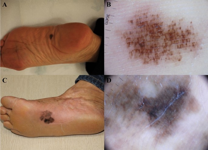 acral_melanoma.jpg