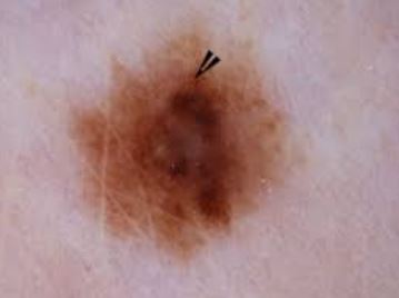 melanoma.jpg